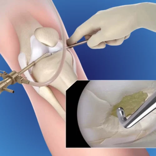 Tennis Elbow and Golfer’s Elbow: Symptoms & Treatments