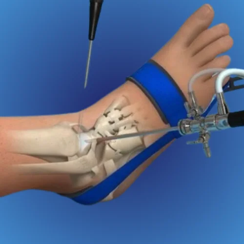 Ankle Sprains: Recovery Tips and Prevention