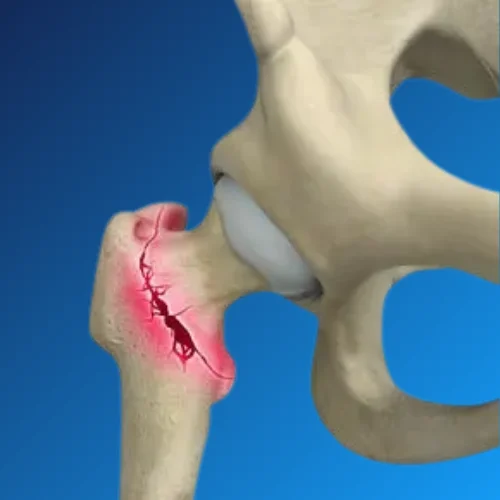 Hip Arthroscopy Surgery
