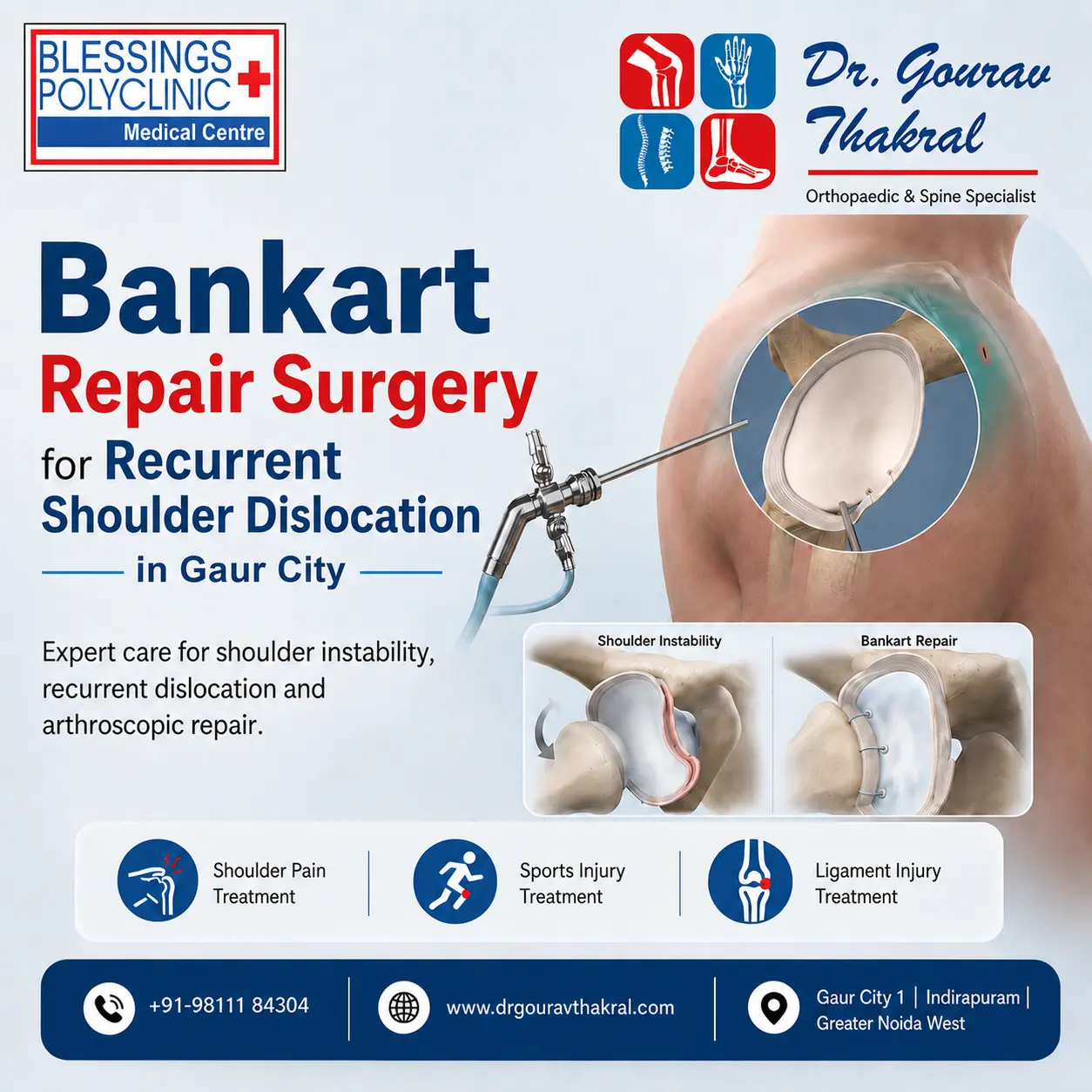 Bankart Repair Surgery in Gaur City: Treatment for Recurrent Shoulder Dislocation