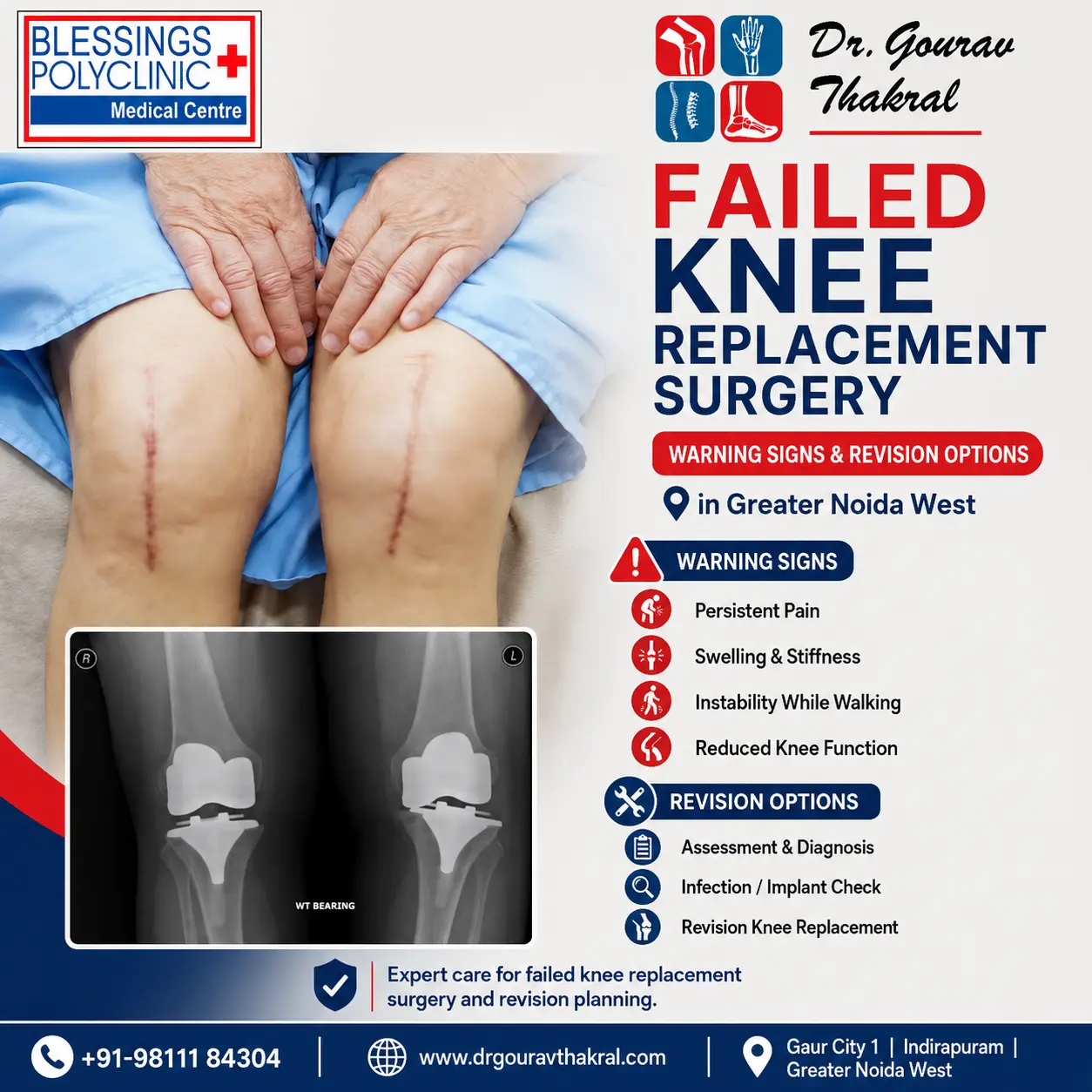 Failed Knee Replacement Surgery in Greater Noida West: Warning Signs and Revision Options