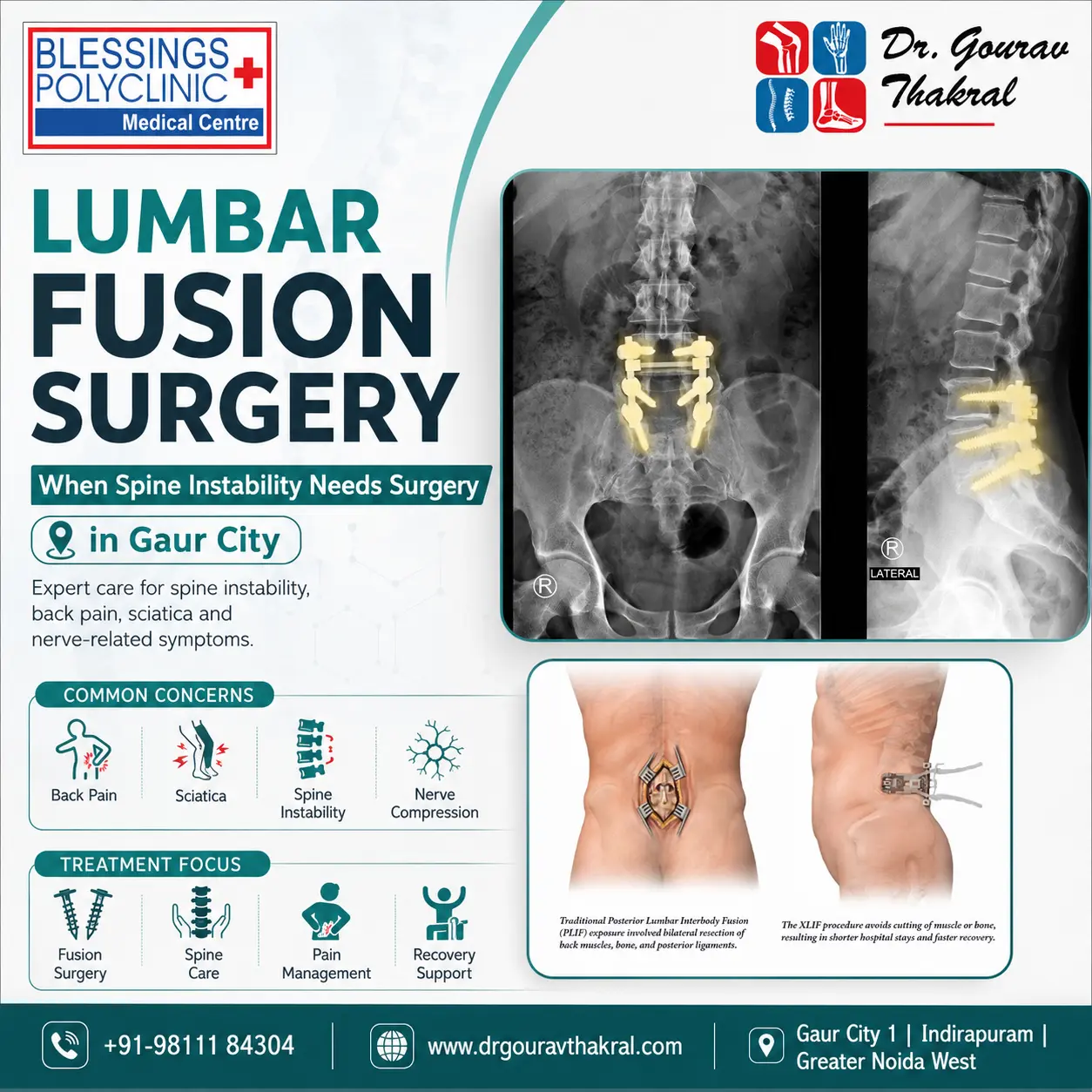 Lumbar Fusion Surgery in Gaur City: Treatment for Spine Instability and Nerve Pain