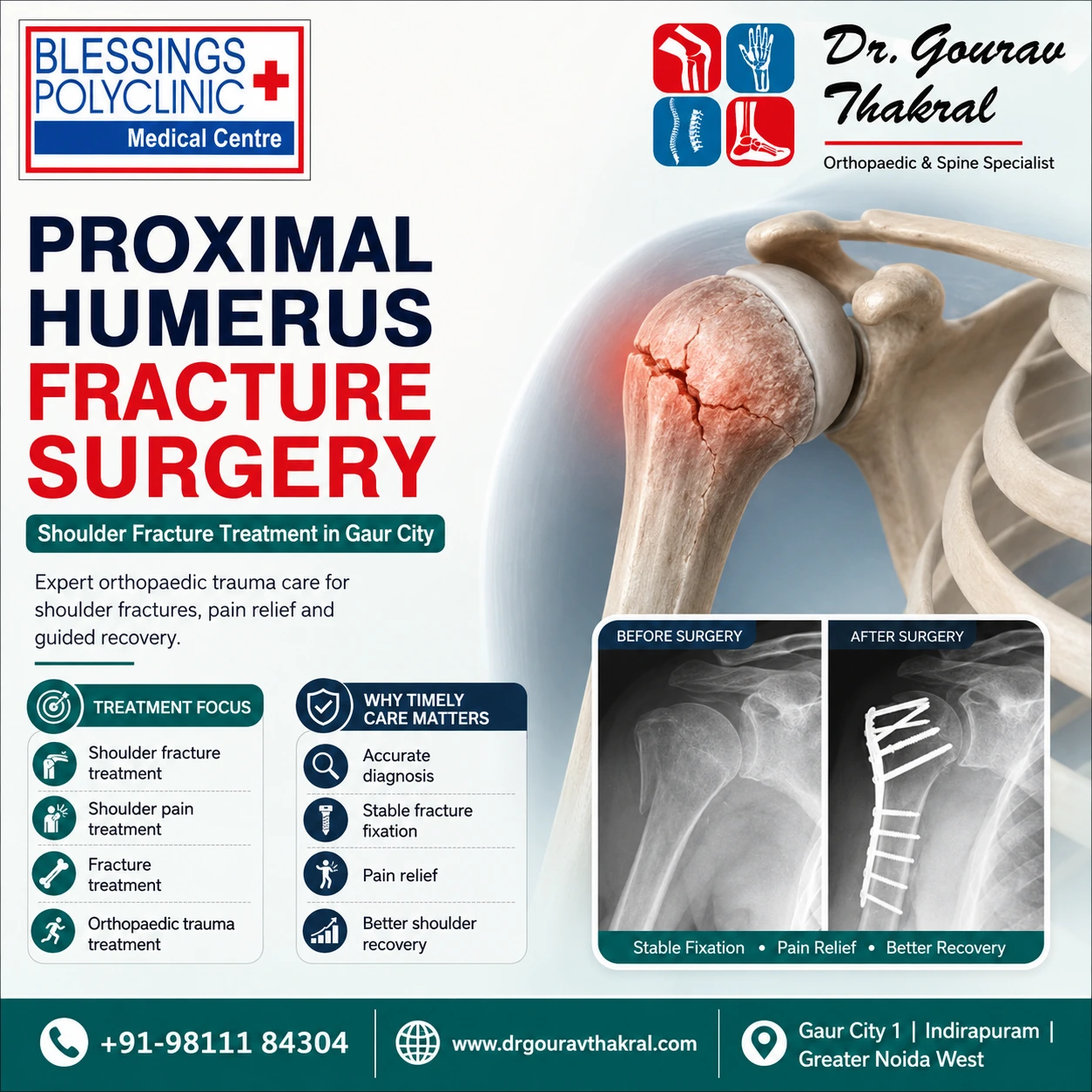 Proximal Humerus Fracture Surgery in Gaur City: Shoulder Fracture Treatment