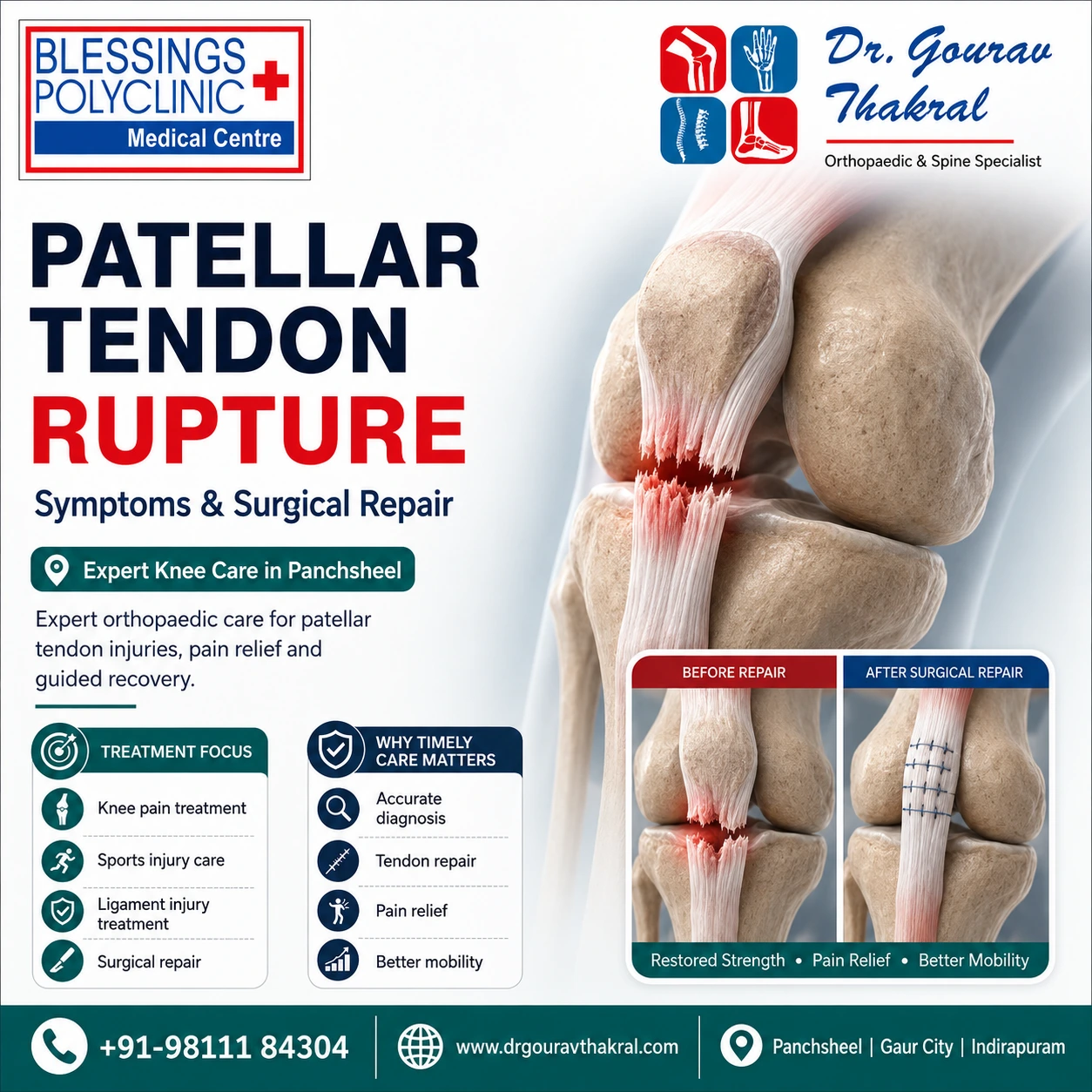 Patellar Tendon Rupture Treatment in Panchsheel: Symptoms and Surgical Repair