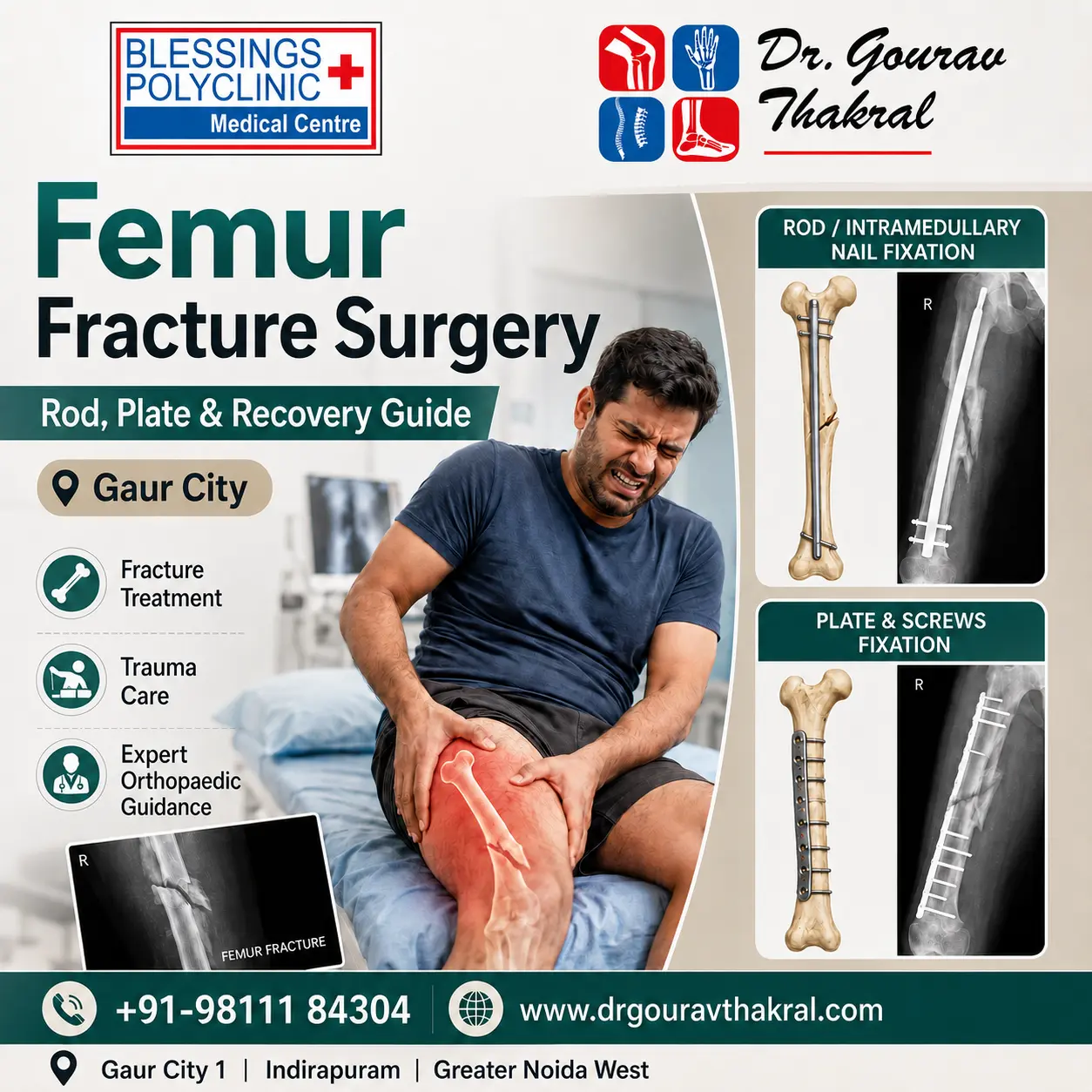 Femur Fracture Surgery: Rod, Plate and Recovery Guide in Gaur City
